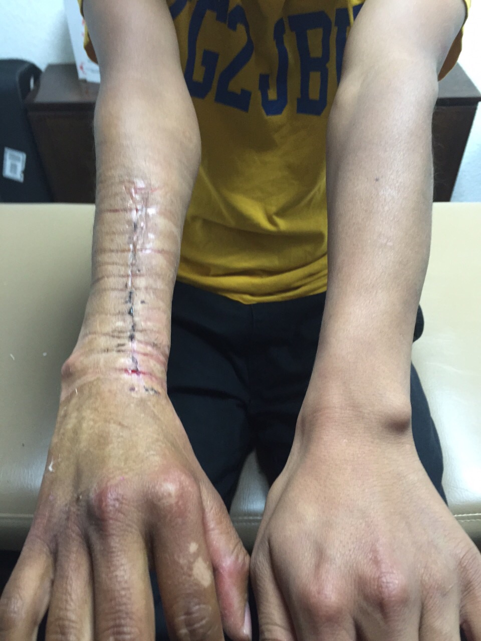 Emmanuel's reconstructive surgery. It is not pretty but you should have seen it before.