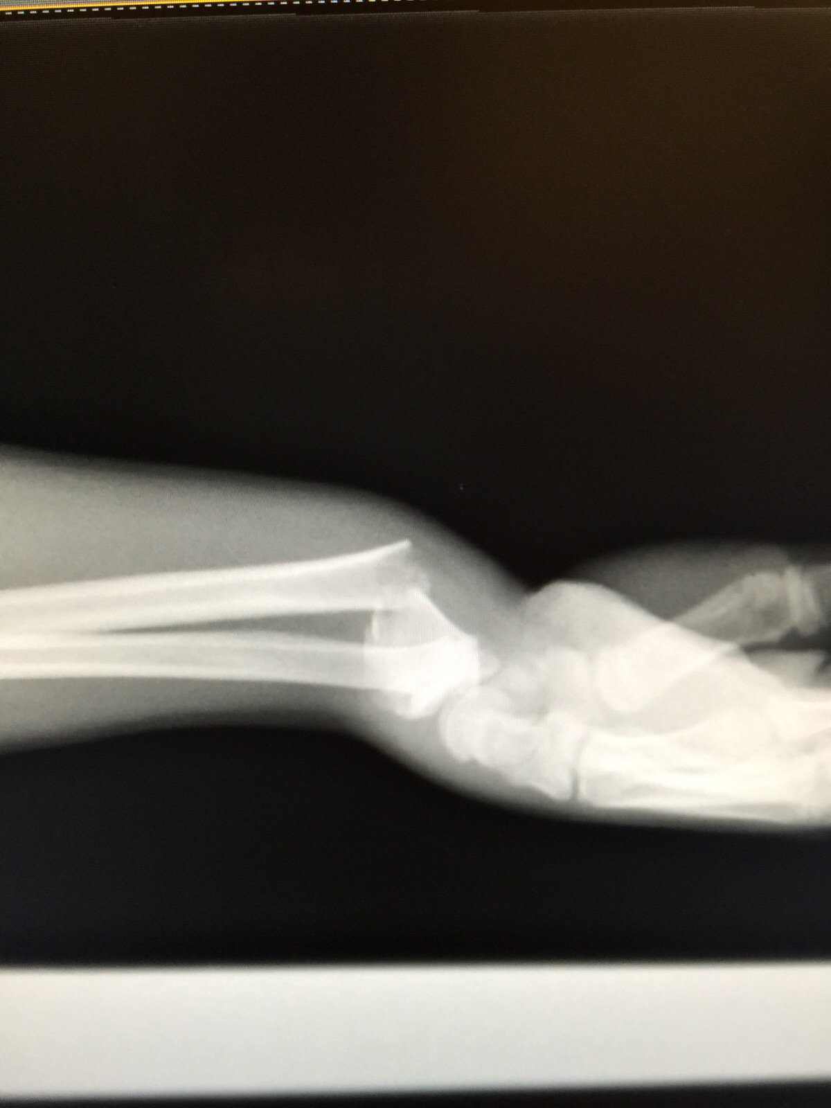 Alfaro's arm before surgery